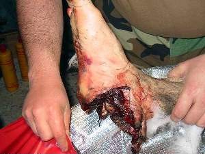 This is a footmine injury, but typical of the type of injury that would result from a 20mmHEI exploding near your foot